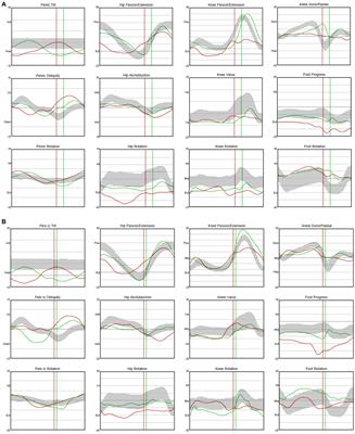 Case report: Intrathecal baclofen therapy improved gait pattern in a stroke patient with spastic dystonia